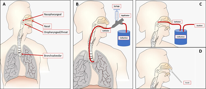 用于呼吸道病毒檢測(cè)的微流體樣品制備
